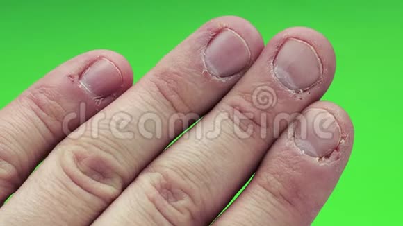 伙计绿色背景下啃指甲的问题手这种病咬指甲和角质视频的预览图