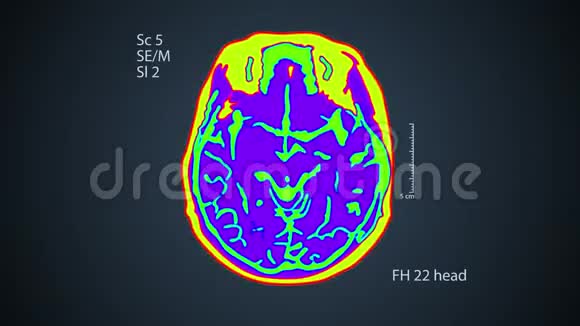 脑MRT扫描屏幕上的一个视图4k医用彩色背景视频的预览图