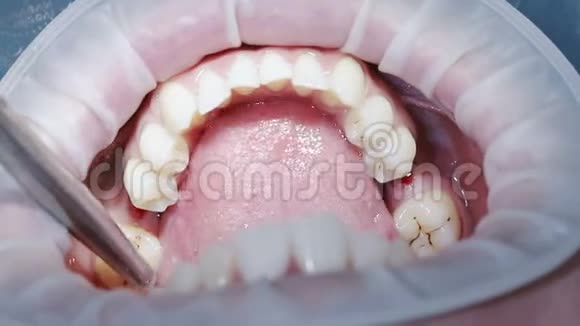 牙种植体安装操作头骨的特写视频的预览图