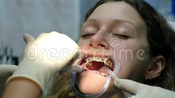 安装金属牙套特写拜访牙医正畸医生纠正咬合视频的预览图