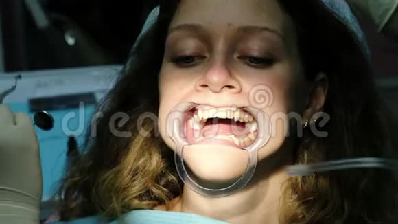 女人正在用口腔内的正畸固定器治疗牙齿去看牙医视频的预览图