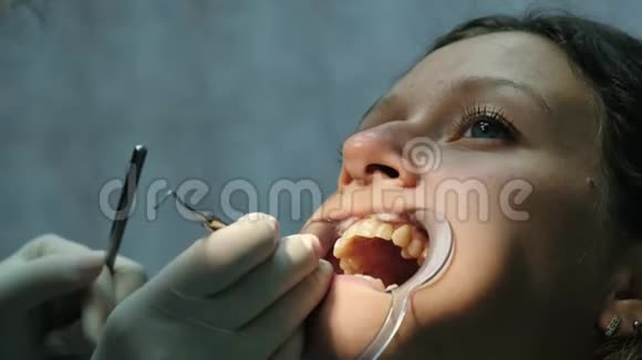 女人正在用口腔内的正畸固定器治疗牙齿去看牙医视频的预览图