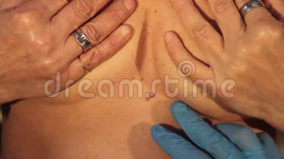 女病人触诊时戴蓝色手套的医生控制乳房上的痣视频的预览图