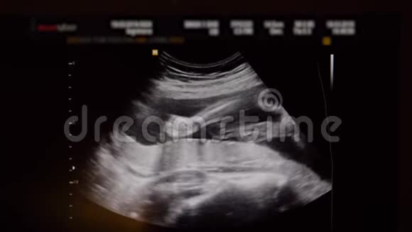 孕中期婴儿超声监测视频的预览图