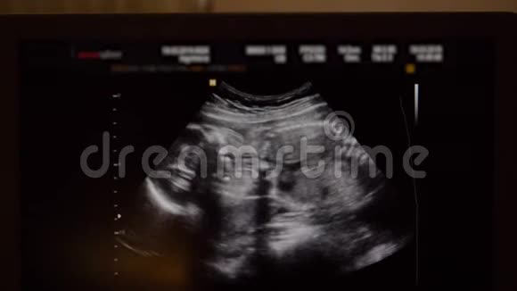 孕中期儿童超声监测视频的预览图