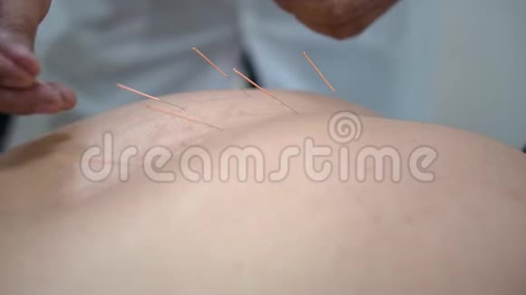 针灸人的特写有针扎在后面中药配合针灸人类恢复健康视频的预览图
