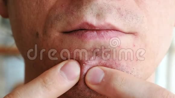 剃须后皮肤刺激男人双手捏着下巴上的疙瘩特写下巴嘴唇和鼻子视频的预览图
