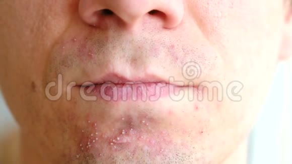 剃须后皮肤刺激男人下巴上的粉刺特写鼻子嘴唇和下巴视频的预览图