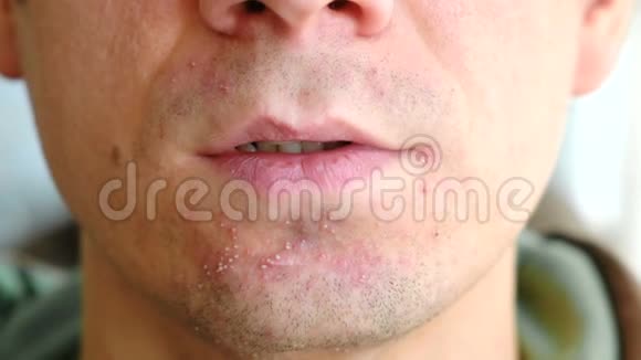 剃须后皮肤刺激男人下巴上的小疙瘩特写视频的预览图