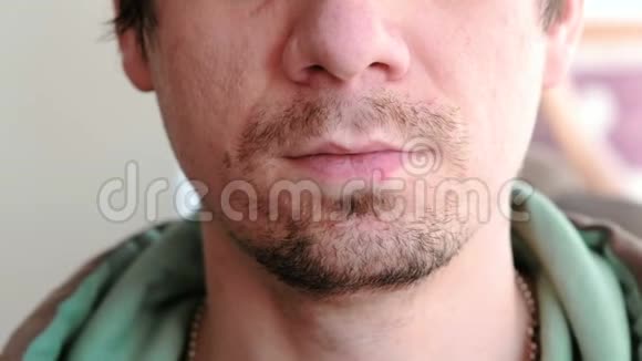 疱疹嘴唇治疗男人嘴唇疱疹的特写前景视频的预览图