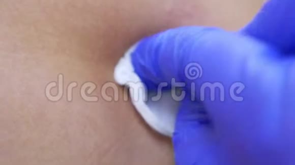 一个皮肤科医生一个医生从一个带有防腐剂的人的背部取出的痣上涂抹一个疤痕4k视频的预览图