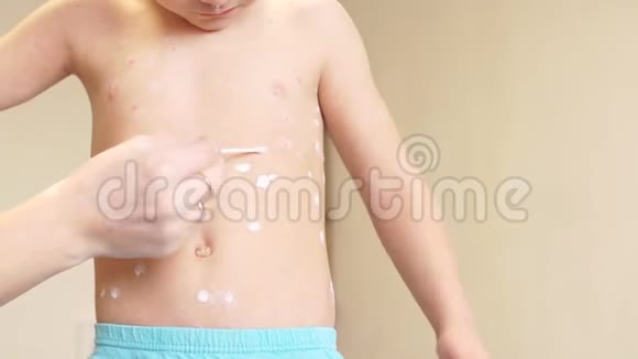 有水痘的小男孩妈妈给皮疹涂防腐乳视频的预览图
