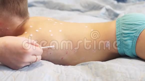 有水痘的小男孩妈妈给皮疹涂防腐乳视频的预览图