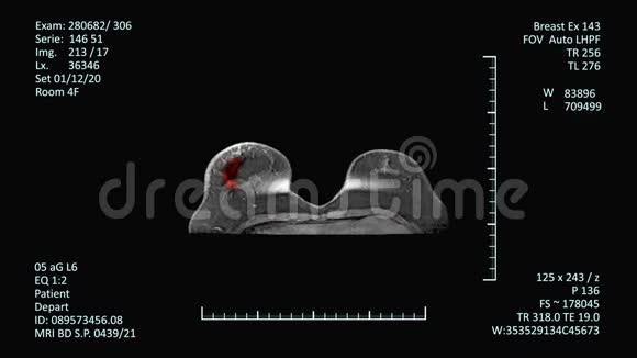 乳腺癌检测MRI扫描监视器视频的预览图