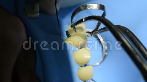 牙科手术室牙齿的特写镜头视频的预览图