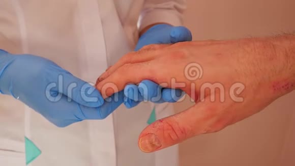 医生检查病人的手上皮炎特写视频的预览图