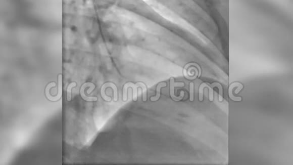 左心室灌注导管造影剂心脏X线功能评估视频的预览图