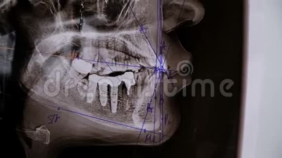牙医展示了一个治疗牙齿横向x光的计划安装支架系统前的咨询视频的预览图