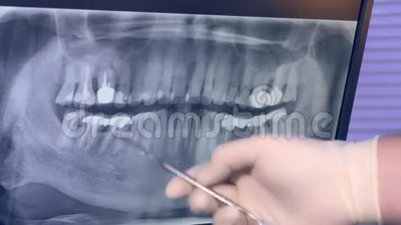 监视器上牙齿的全景X线片和医生用工具手套视频的预览图