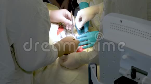 外科医生在手术中从颈动脉中取出血块他得到许多专家的协助非常复杂视频的预览图