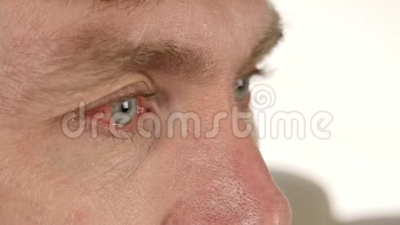 常见的眼睛感染和炎症人滴液体药物到他的眼睛4K视频的预览图
