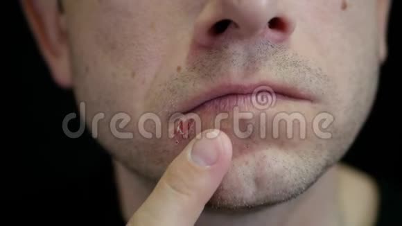 一个男人在黑色背景下摸着嘴唇上的溃疡疱疹嘴唇治疗视频的预览图