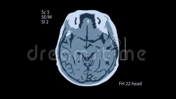 脑MRT扫描黑色屏幕上的一个视图4k医学背景视频的预览图