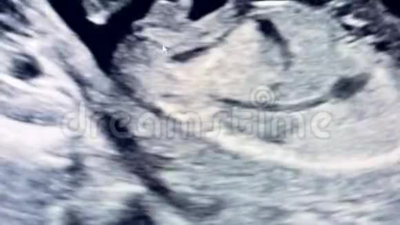胎儿在母亲子宫里是在做超声波检查时移动的视频的预览图
