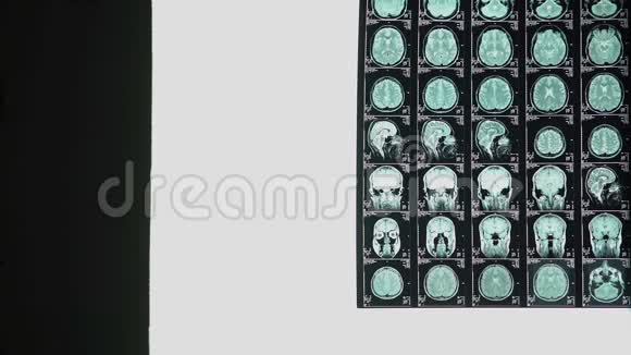 神经外科医生分析脑部x光血管问题不治之症视频的预览图