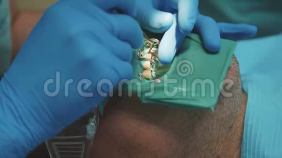 牙科医生用围堰治疗病人4K视频的预览图