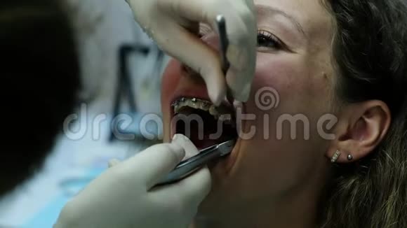 拜访牙医安装支架系统正畸师在一个金属正畸弓上视频的预览图