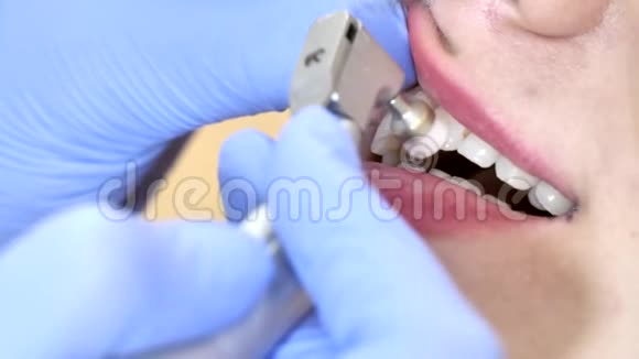 给女病人治牙口腔医生把牙齿清理干净视频的预览图