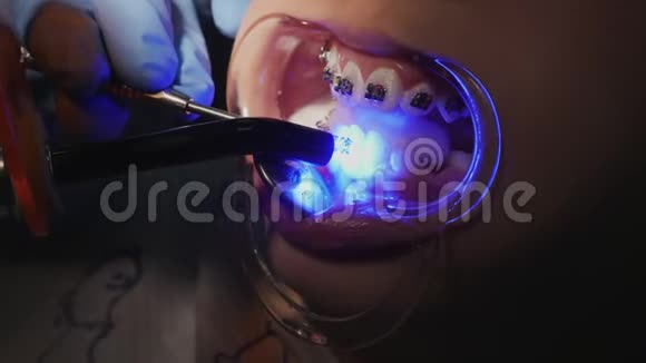 正畸医生用光聚合物灯照在牙齿上视频的预览图