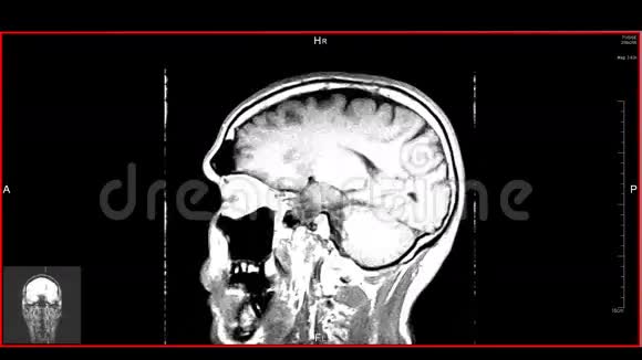脑顶MRT扫描视频的预览图