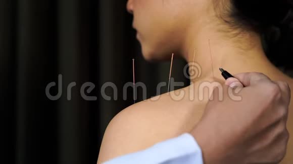 肩扛电刺激器进行针灸治疗的妇女视频的预览图