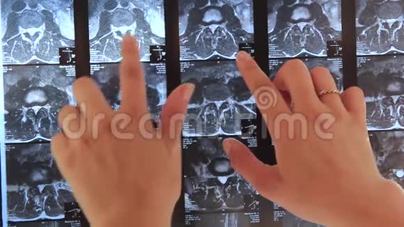 医生他的手在X光片上显示背面的问题区域视频的预览图