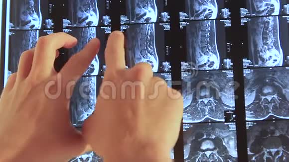 医生他的手在X光片上显示背面的问题区域视频的预览图