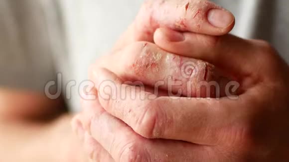 银屑病和湿疹的男性手指皮肤剥落的特写视频的预览图