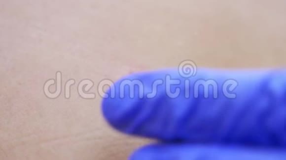 皮肤科医生在激光手术前在男性背部的痣上注射麻醉视频的预览图