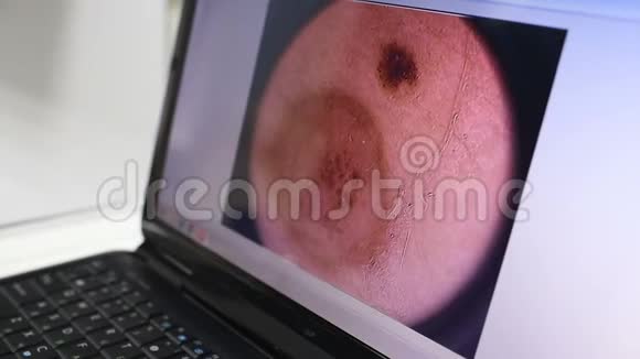 笔记本显示器上的胎记或疣的特写图像视频的预览图