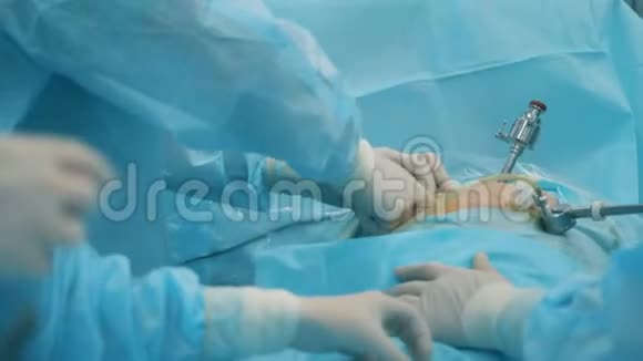 一组外科医生正在进行腹腔镜手术视频的预览图
