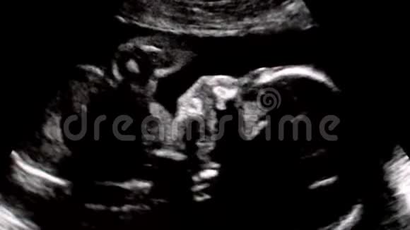 妊娠中期超声检查视频的预览图