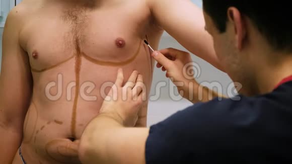 一位整形外科医生为吸脂和脂肪雕塑的手术画了一个标记病人是人人美视频的预览图