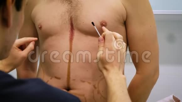 一位整形外科医生为吸脂和脂肪雕塑的手术画了一个标记病人是人人美视频的预览图