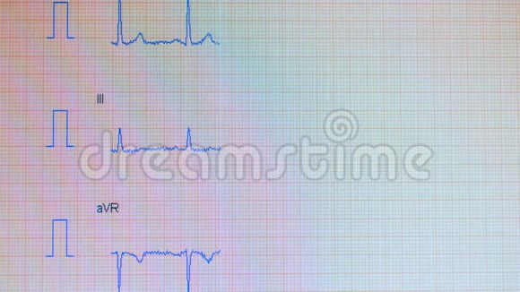心脏脉搏线心电图过程显示在屏幕上视频的预览图