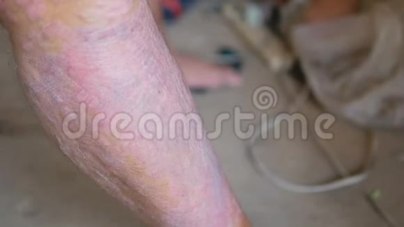 银屑病患者使用草药使用自己的腿与伤口视频的预览图
