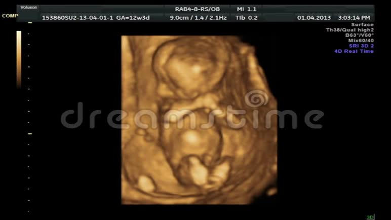 4D婴儿超声扫描视频的预览图