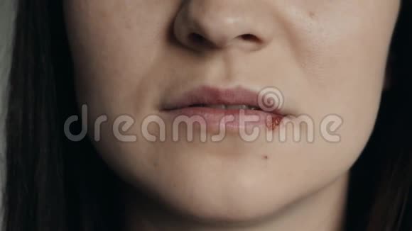 年轻女人嘴唇上的疱疹女人抹黑疱疹和疱疹膏视频的预览图
