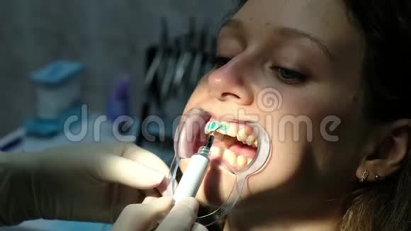 牙医在安装支架之前在牙闩上的妇女身上涂上一种特殊的正畸蓝胶视频的预览图