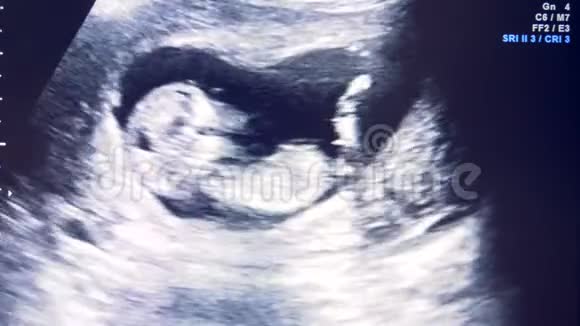 胚胎发育过程显示在监视器上的声像图视频的预览图